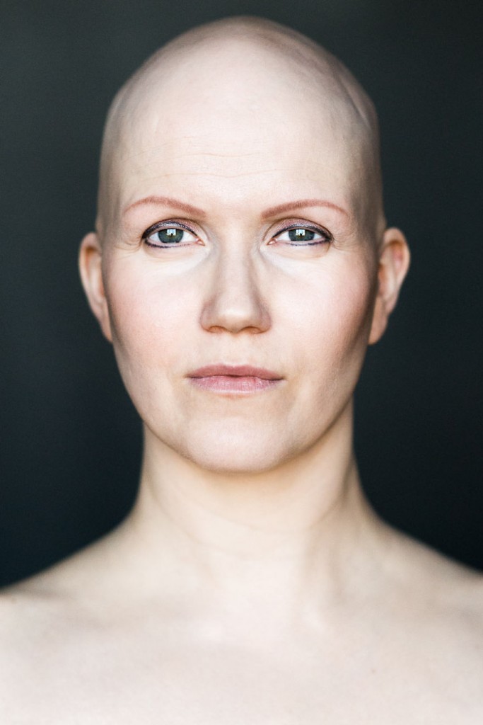 Women With Alopecia Captured In Beautiful Pictures 