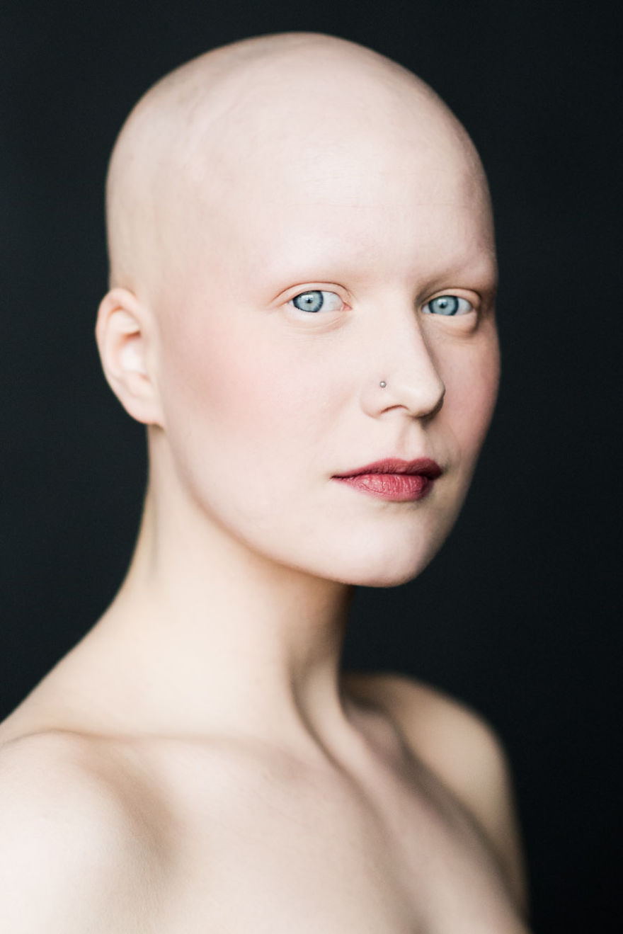 Women With Alopecia Captured In A Beautiful Series Of