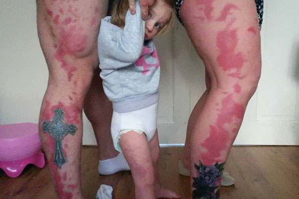 parents-tattoo-toddler-birthmark-honey-rae-4