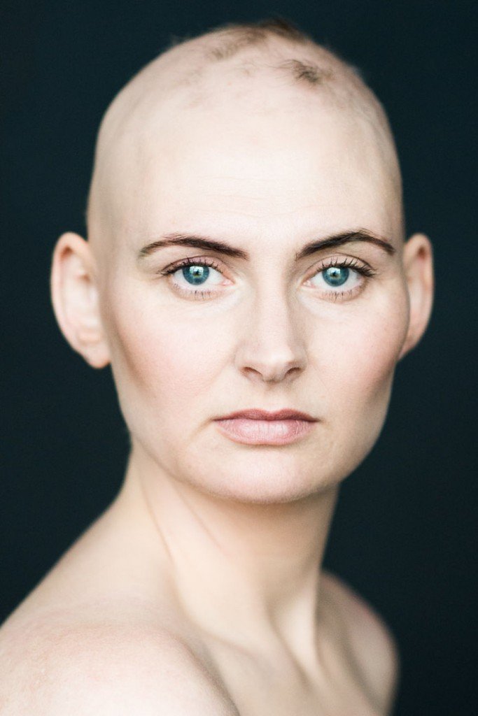 Women With Alopecia Captured In Beautiful Pictures Challenging Gender 