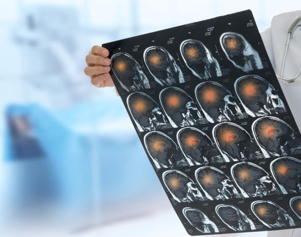 What Are the Causes of Brain Hemorrhage During Birth - art-sheep.com
