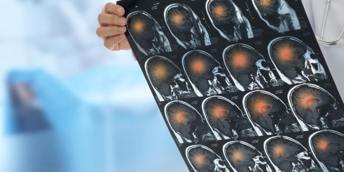 What Are the Causes of Brain Hemorrhage During Birth - art-sheep.com