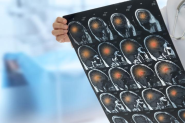 What Are the Causes of Brain Hemorrhage During Birth - art-sheep.com